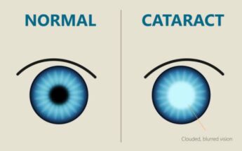 How Technology is Changing the Lives of Cataract Sufferers Today